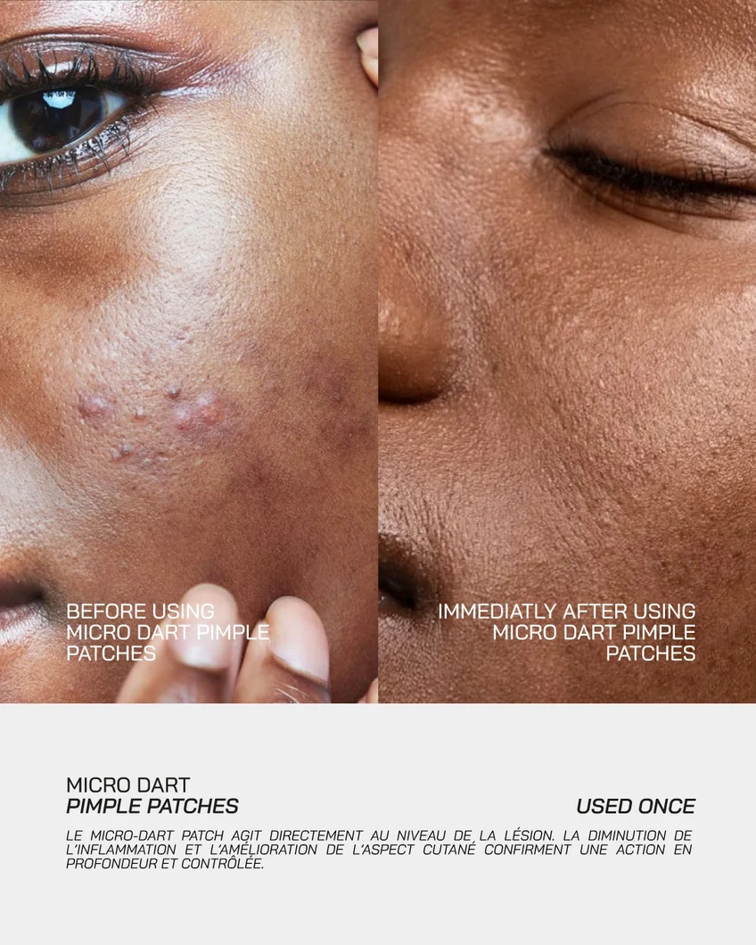 NOVERA™ Microneedle Blemish & Tag Patches